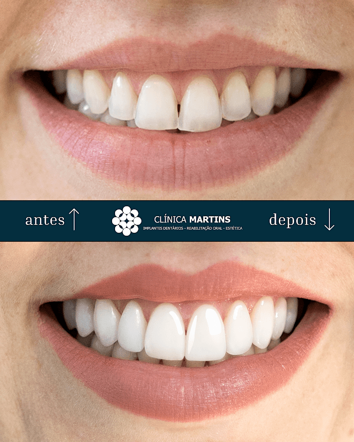 Depois — Resultado real